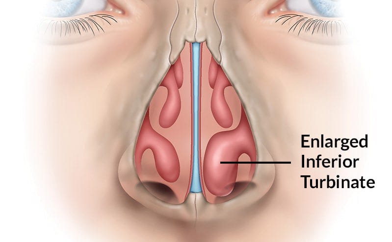 Turbinate Reduction St Louis & Festus MO