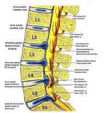 File:Lumbar Disc Lesions Classification.jpg - Wikimedia Commons