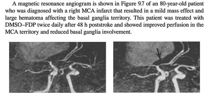 dmso angiogram