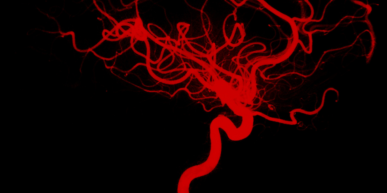 Adding anticoagulation to thrombolytics for acute ischemic stroke (MOST trial)