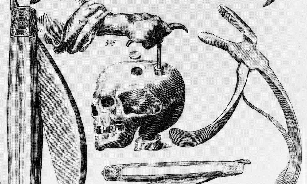 A Hole in the Head: A History of Trepanation | The MIT Press ...