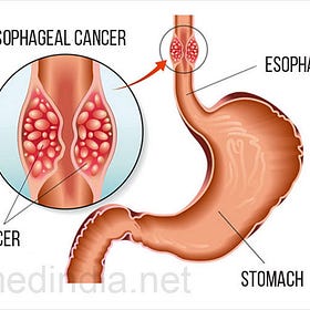 Case Report: Squamous Cell Esophageal Cancer, age 74, Male