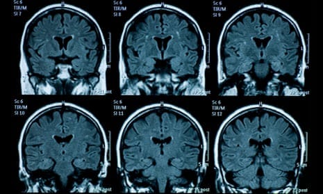MRI scan of brain
