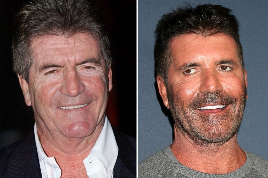 Too Much BTX: Botulinum toxin Gone Wrong - Dr Rachel Ho