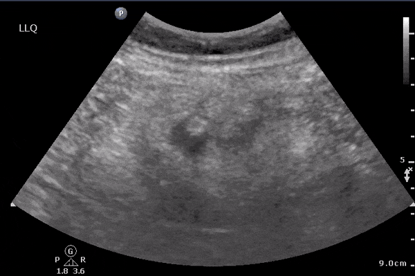 Diverticulitis sure looks a lot like a tiny appy that's ... | GrepMed