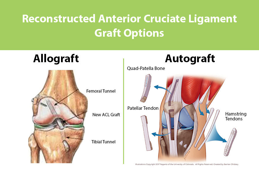 What Type Of Graft Should I Choose For My ACL Reconstruction Surgery? — The  Knee Joint