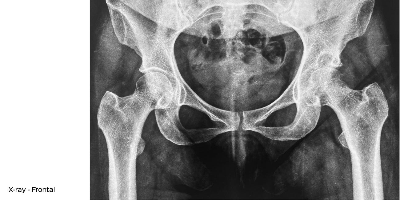 Case 38: Holes in the Hip