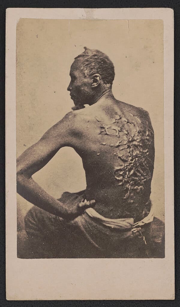 A man sits with his back to the camera. His back is full of scars and ridges in the skin from beatings. 