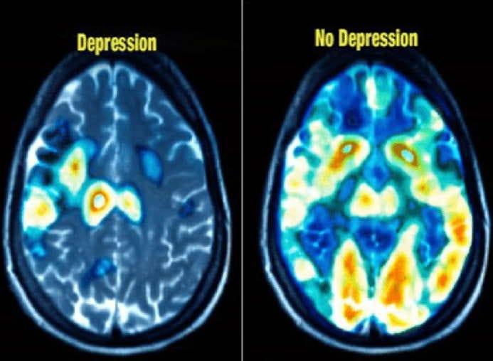 depression mental health brain training self-awareness attitude thinking counseling therapy l incoln stoller