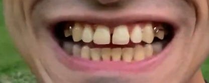 Suture split/Diastema