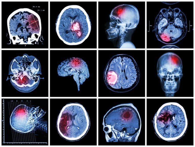 Common Test and Procedures for Brain Injuries in Indiana