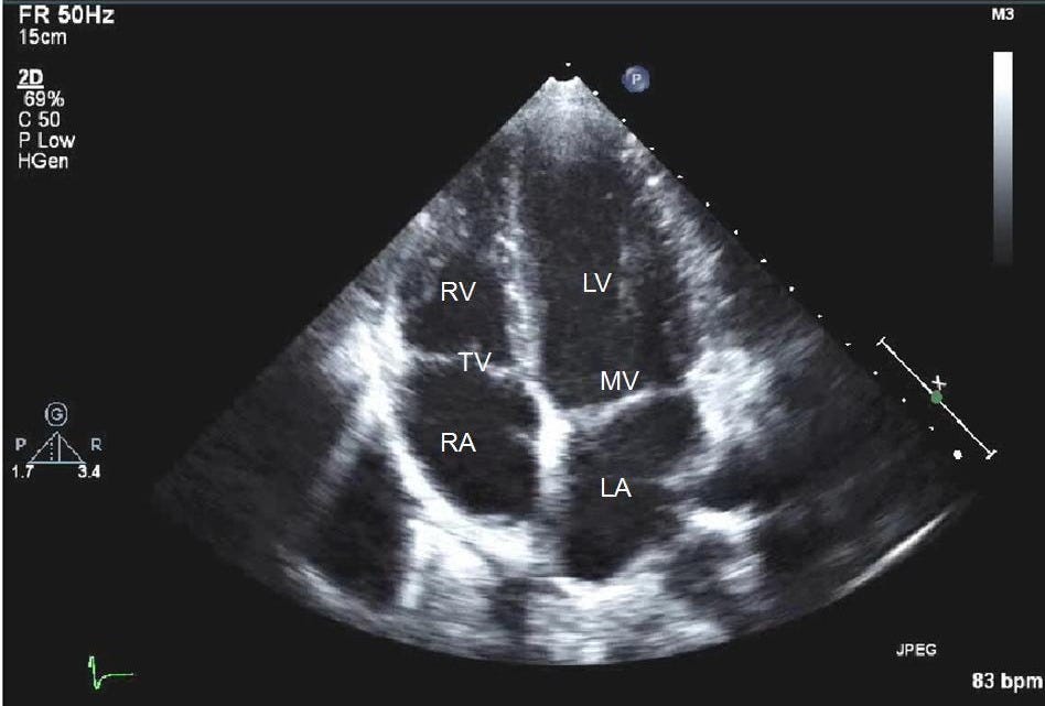 Echocardiogram (echo) - Dysautonomia-MVP Center - Paula ...