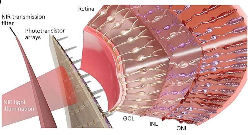 This artificial retina doesn't just aim to restore sight—it opens a hidden channel of vision