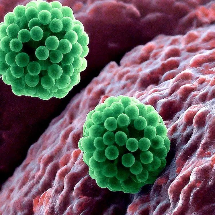 Microscopic algae-bots delivering chemotherapy drugs to lung tumors. A microscopic image showing algae-bots, shaped like spheres, releasing green chemotherapy drugs near lung tumor cells.