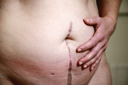 Image of an abdomen with a surgical scar from belly button down. Image of an abdomen with a surgical scar from belly button down.