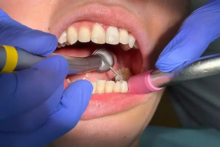 Making Quieter Dental Drills to Reduce Dental Anxiety Making Quieter Dental Drills to Reduce Dental Anxiety