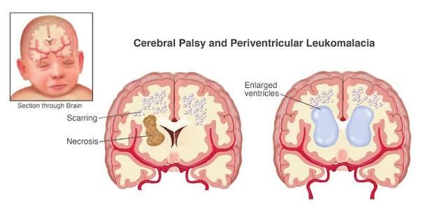 Intraventricular Hemorrhage and Periventricular Leukomalacia Intraventricular Hemorrhage and Periventricular Leukomalacia