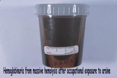 "Blackwater" urine due to massive hemolysis, from "Blackwater" urine due to massive hemolysis, from