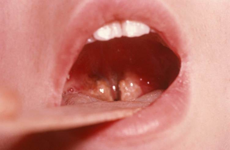 A tongue depressor holds open a person’s mouth so you can see two swollen brownish patches at the entry to the throat. A tongue depressor holds open a person’s mouth so you can see two swollen brownish patches at the entry to the throat.