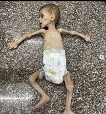Gaza children are dying from starvation