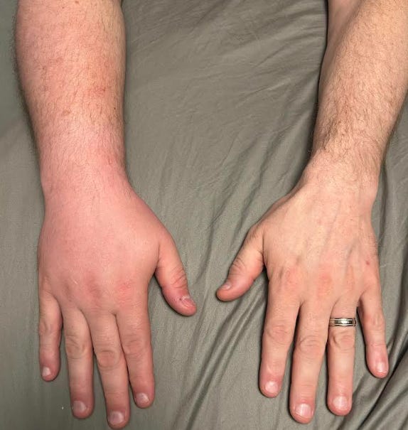 The Risk of Beekeeping