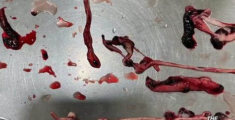 These wormlike blood clots are what develops form self-assembling nanoparticles in the COVID Jabs