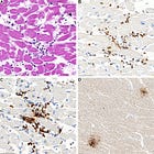 Autopsy reports of myocarditis following mRNA vaccinations