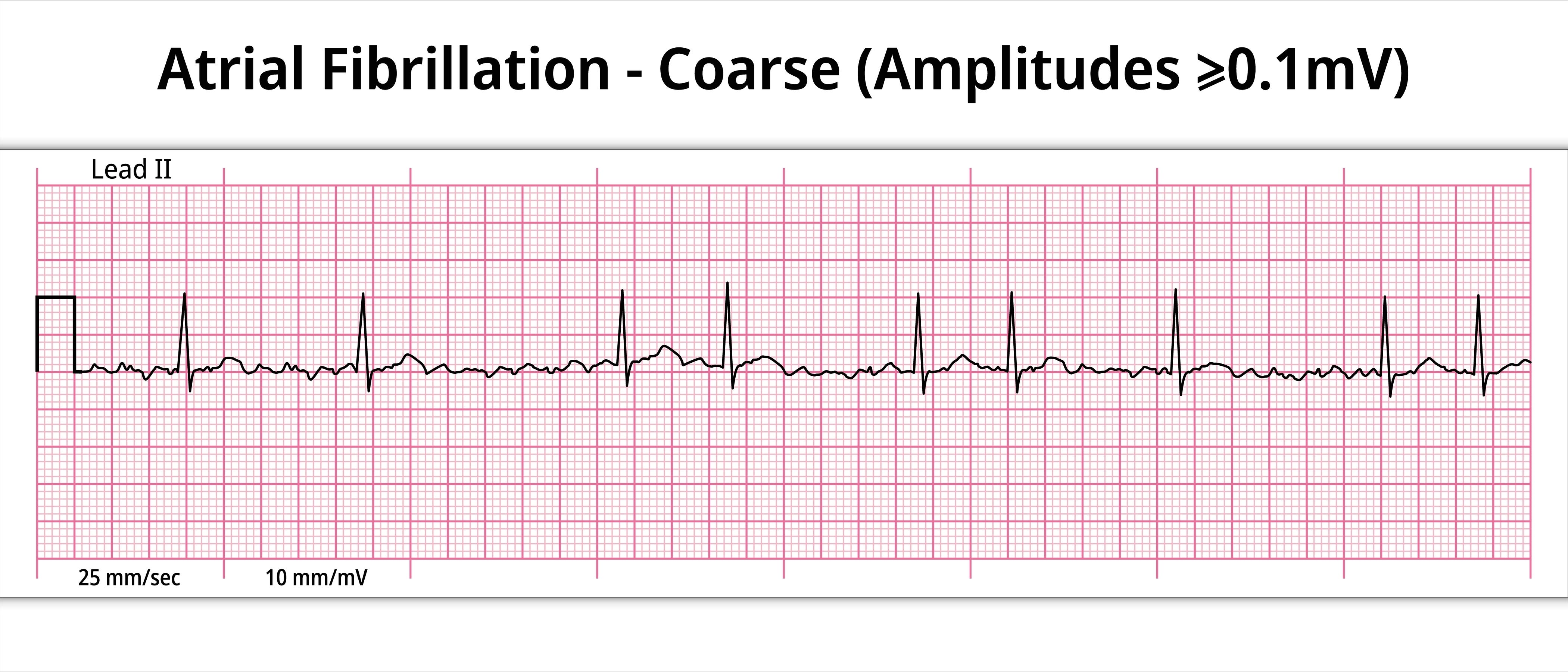 Once a Fibber, Always a Fibber - by Paul D. Thompson, MD