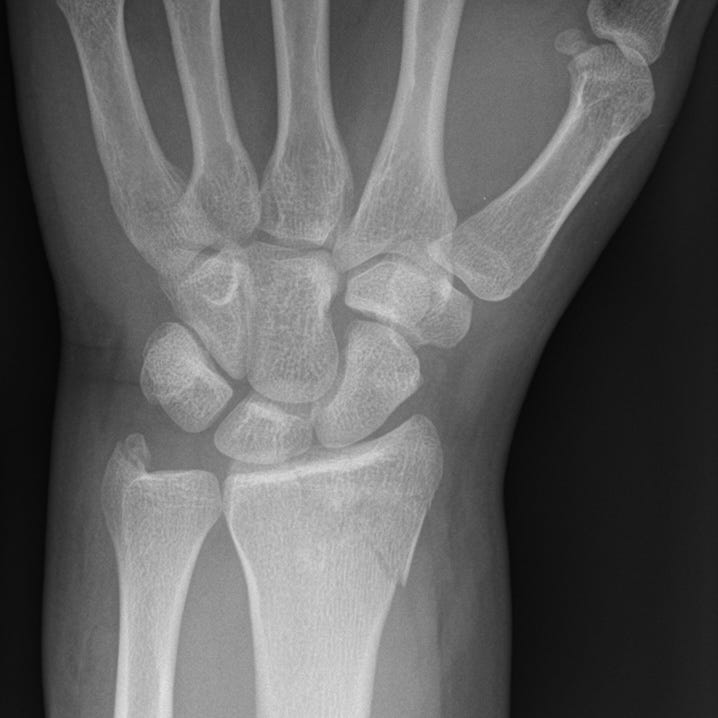 Distal Radial Fractures By Alexander Baxter Radnotes