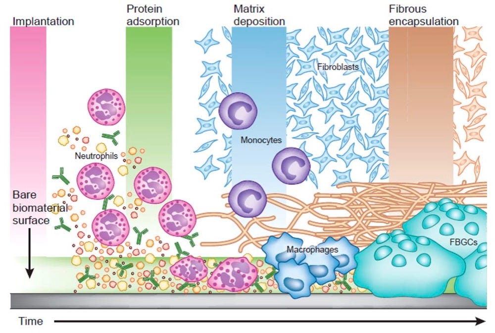 reação de corpo estranho aos bioestimuladores de colágeno