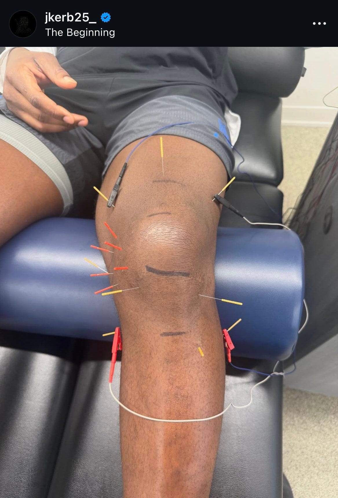Kerby Joseph knee receiving needling therapy with electrical stimulation Kerby Joseph knee receiving needling therapy with electrical stimulation