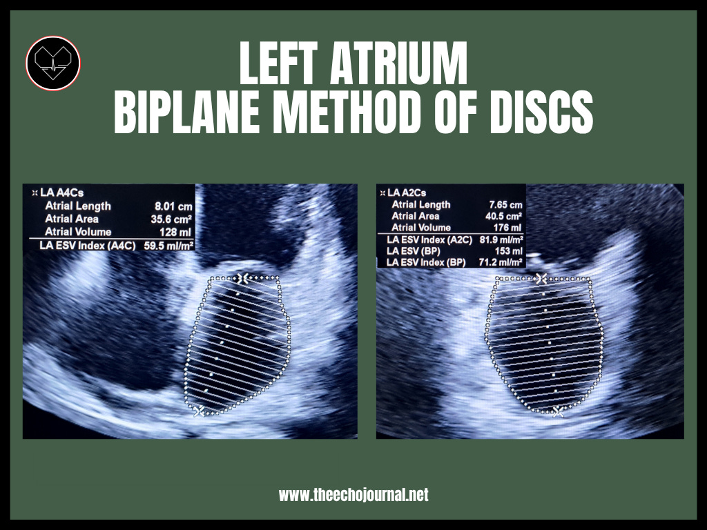 UPDATE! Navigating Diastolic Dysfunction Has Changed — Here’s What You ...