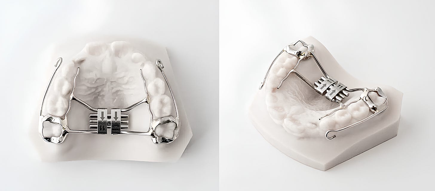 7.6 MARPE + Facemask for Protraction - by Ronald Ead