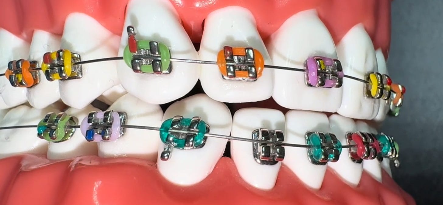 Amazon.com: ARTMAN INSTRUMENTS Dental Braces Color Changing Kit,  Orthodontic Ties Changing kit, Change The Color of Your Braces Yourself in  Minutes Ligas para Brackets Ortodoncia : Health & Household