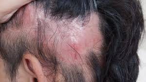 Alopecia (hair loss): types, cause and ...