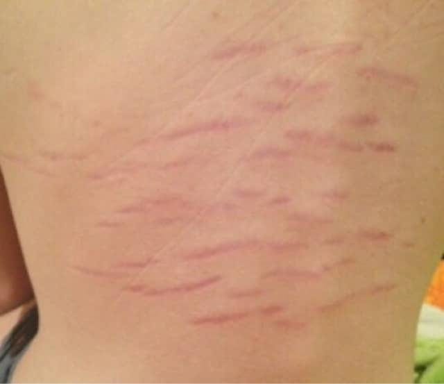 bartonella on human skin