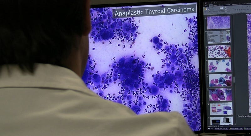 Digipatics. Proyecto de IA para anatomía patológica en diagnóstico de cáncer