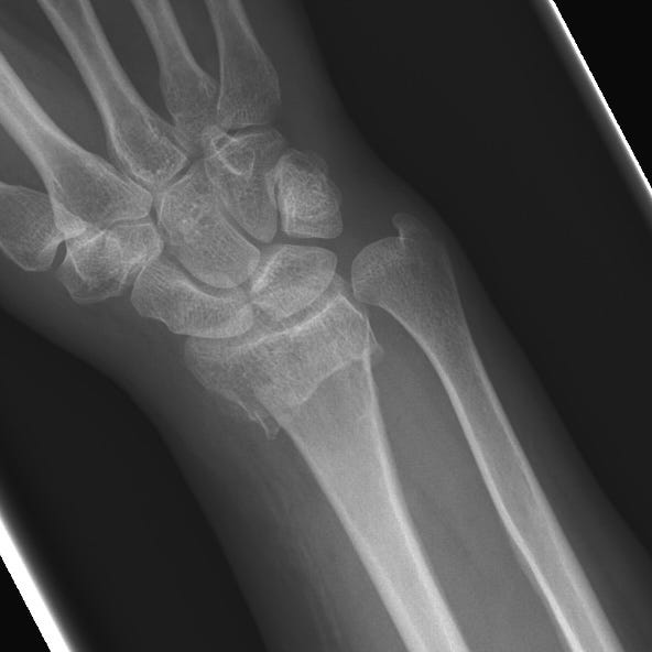 Distal Radial Fractures By Alexander Baxter Radnotes