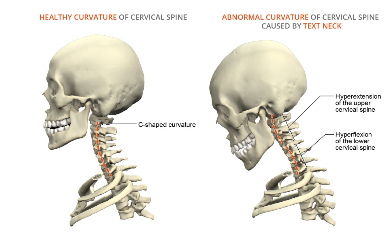 Healthy Neck vs. Tech Neck — notice how forward-head posture increases load on the spine