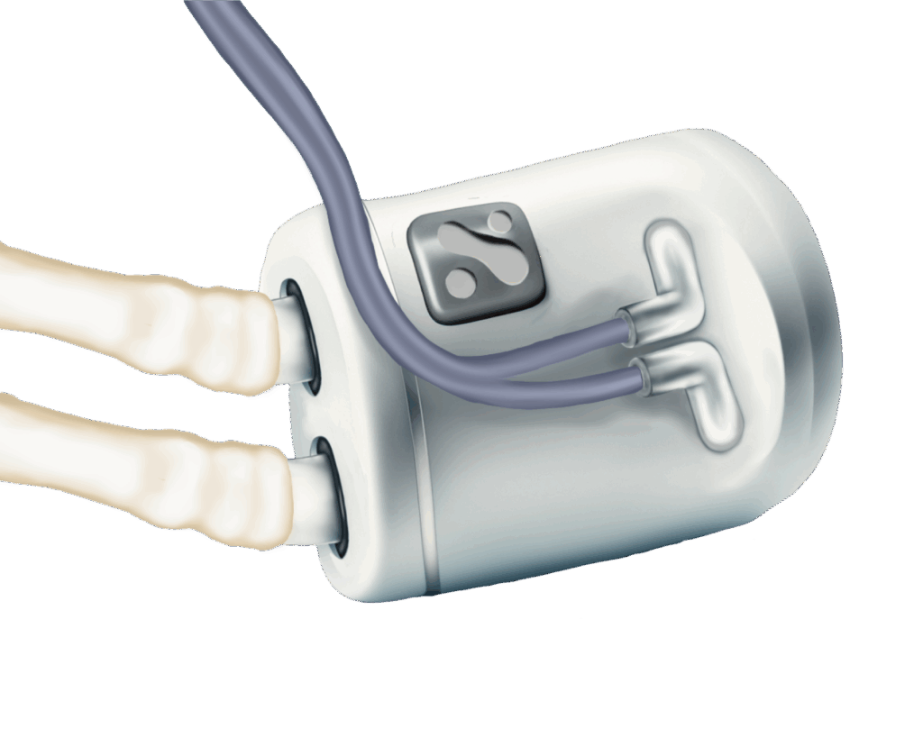 kidney replacement.png