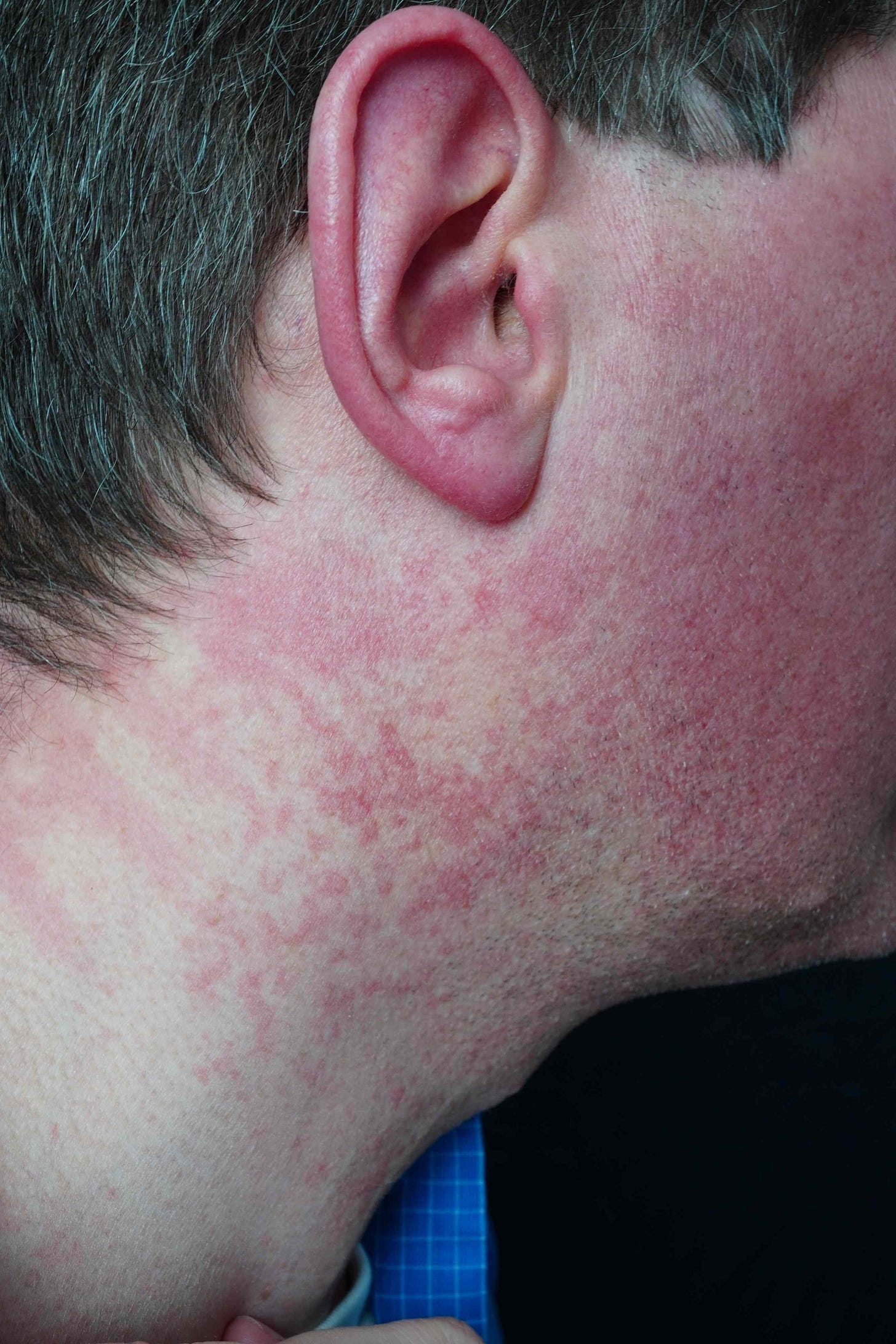 Niacin Flush: Why It Happens and When to Worry