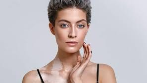 How To Detect Vitiligo? Signs People ...
