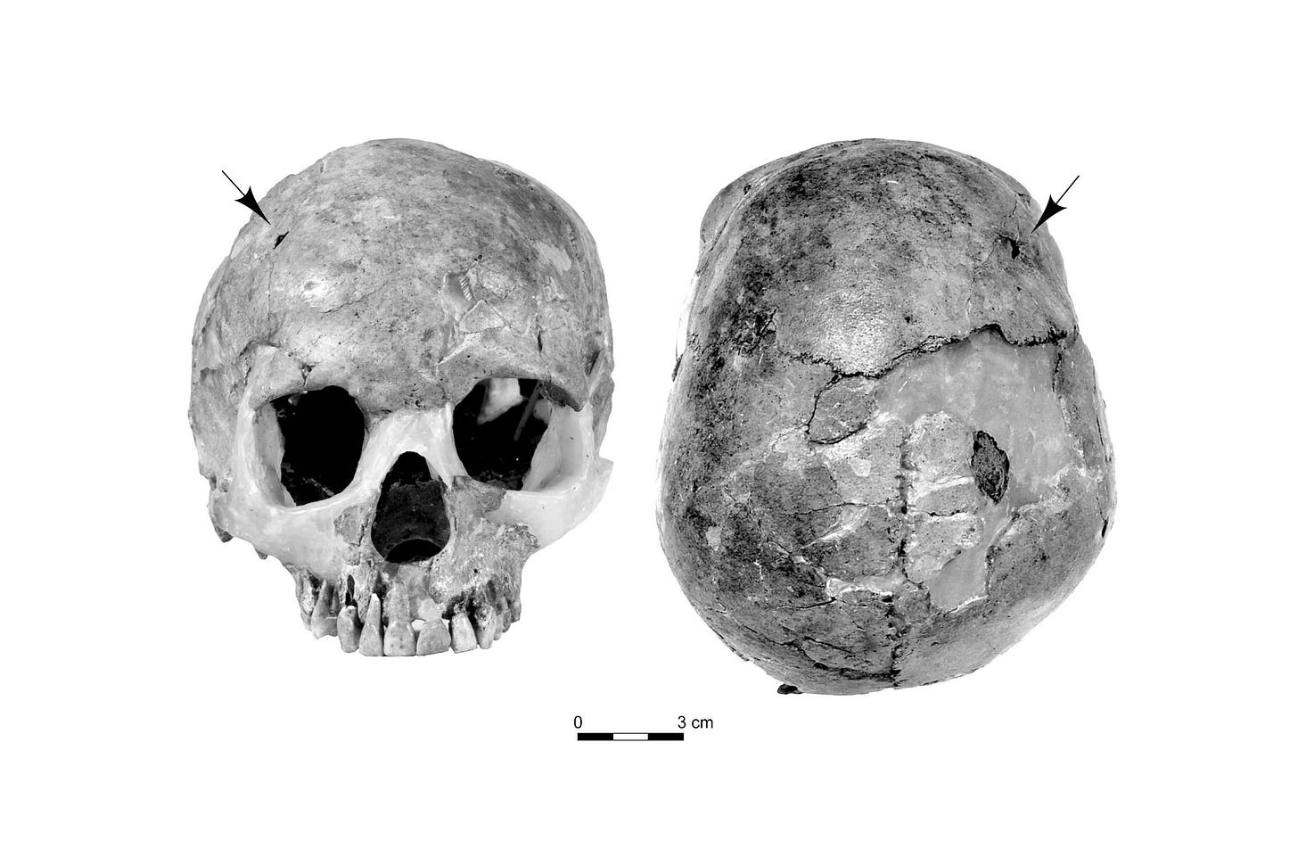 Skull of Qafzeh 11 seen from anterior and superior view with arrows indicating position of cranial fracture
