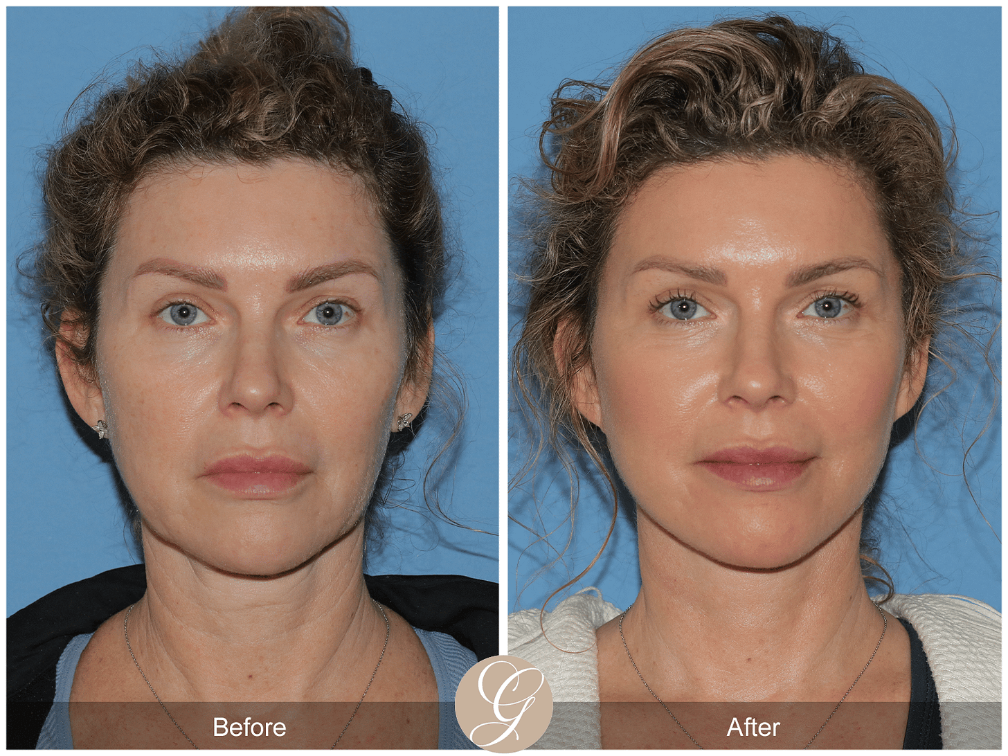 FACELIFT Before After Photos Dr. Sadati - FACE - FACELIFT Orange County CA