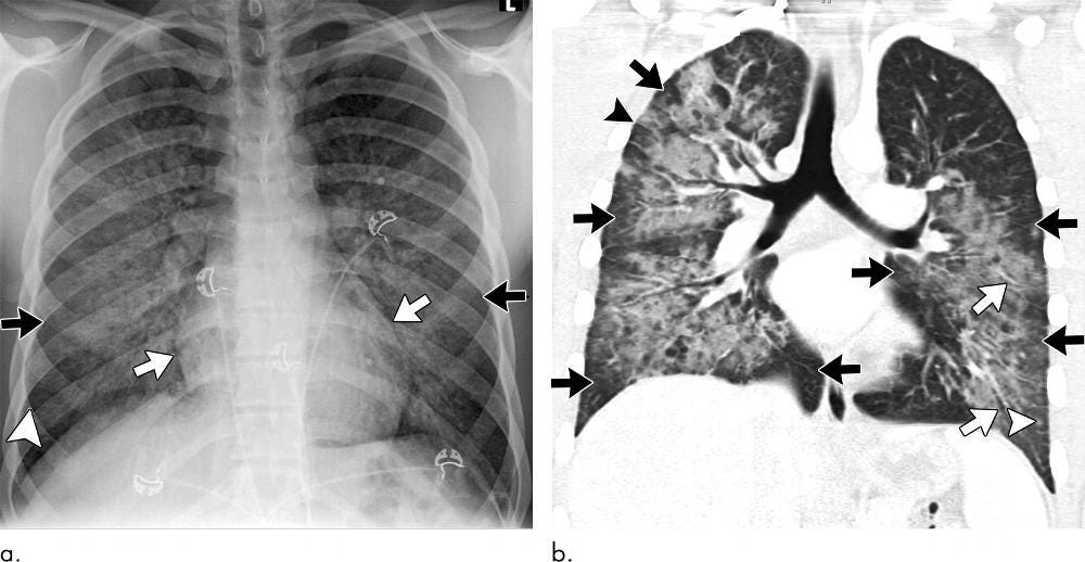 Abnormal Imaging Findings Key to EVALI Diagnosis in Vapers | RSNA Abnormal Imaging Findings Key to EVALI Diagnosis in Vapers | RSNA