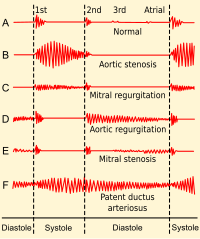 Systolic heart murmur - Wikipedia