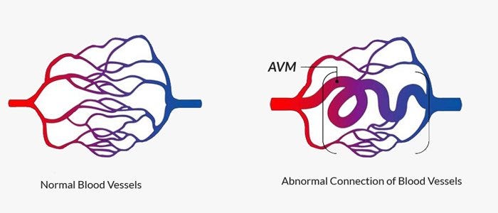 What is an Arteriovenous Malformation (AVM) | Pacific Neuroscience Institute