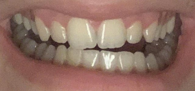 Why is my bite so uneven? will my mewing worsen this? : r/Mewing