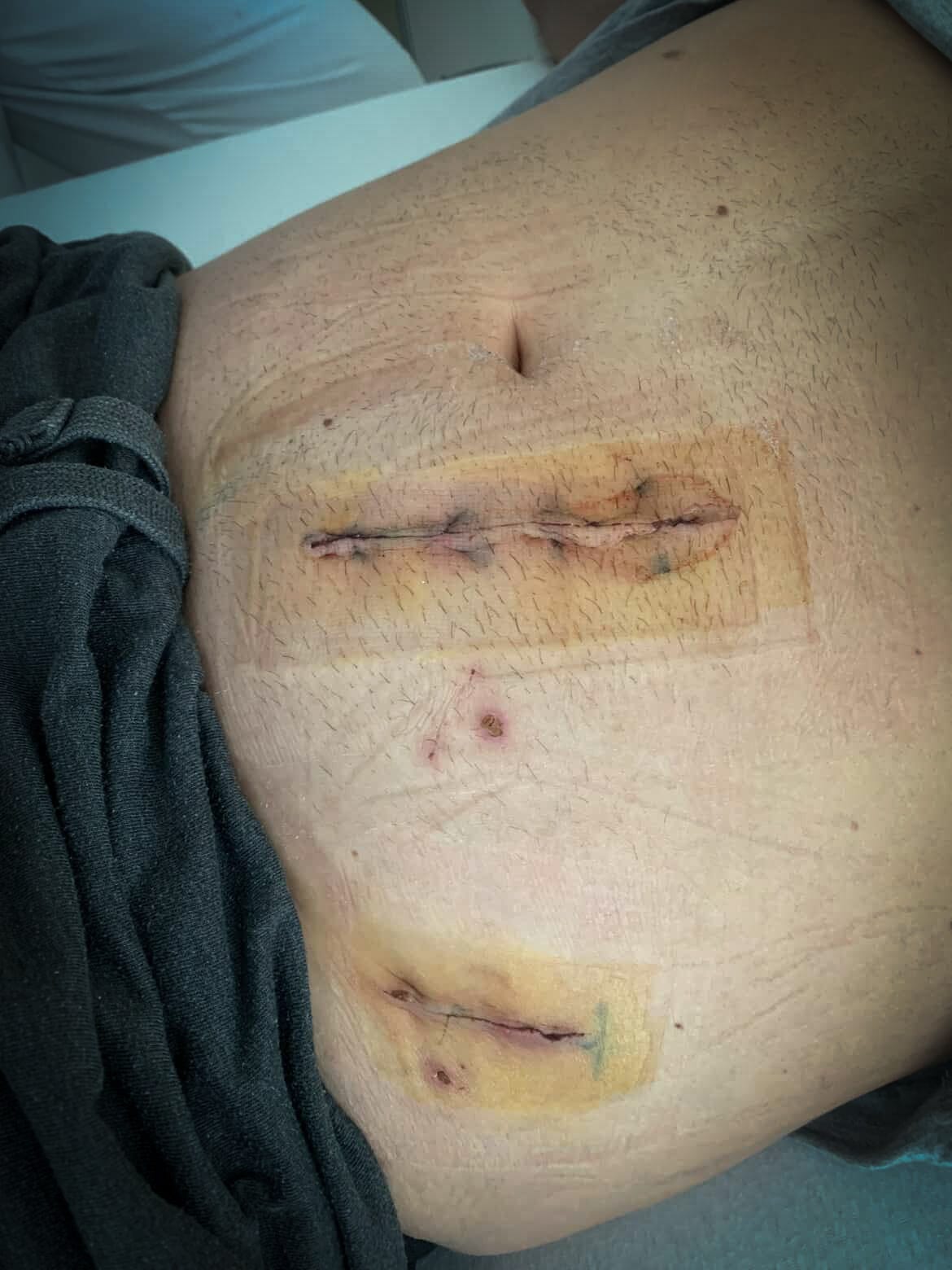Stitchings from the Operation in Question