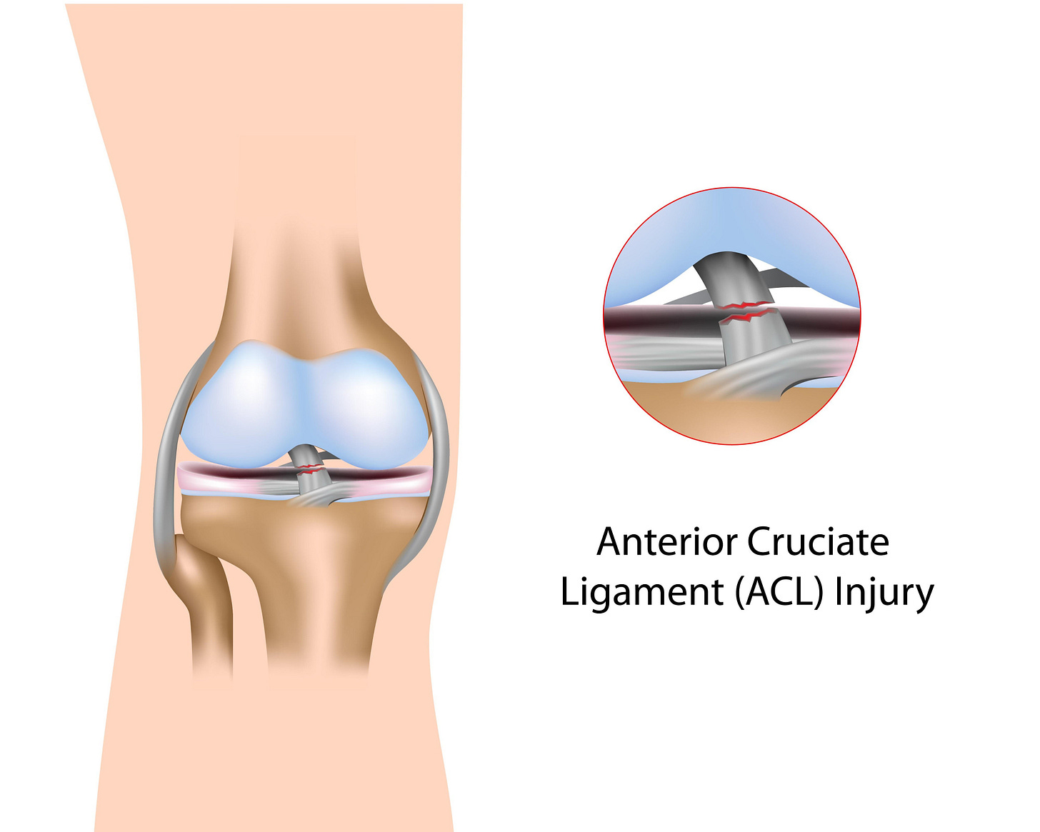 Imagen de anterior cruciate ligament tear anatomy Imagen de anterior cruciate ligament tear anatomy
